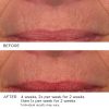 3HA Micro-Needle Wrinkle Strips - Afbeelding 9