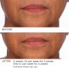 3HA Micro-Needle Wrinkle Strips - Afbeelding 10