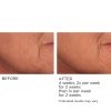 3HA Micro-Needle Wrinkle Strips - Afbeelding 12