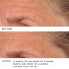 3HA Micro-Needle Wrinkle Strips - Afbeelding 13